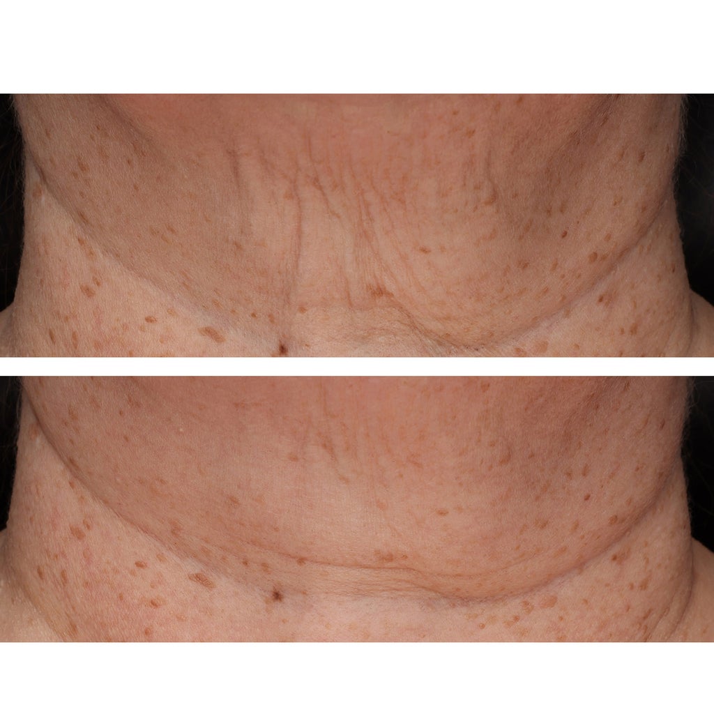 StriVectin TL Advanced Tightening Neck & Chest Lotion, SPF 35, 1.5 fl oz, 2-pack - product image